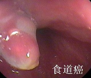 是发生在食管上皮组织的恶性肿瘤,占所有恶性肿瘤的2%