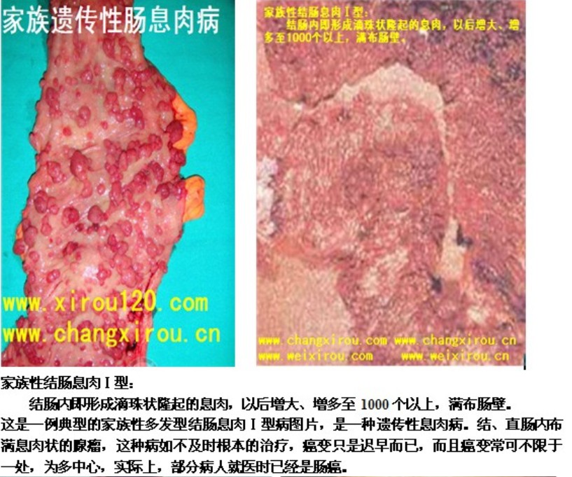 中医治疗肠息肉的理念